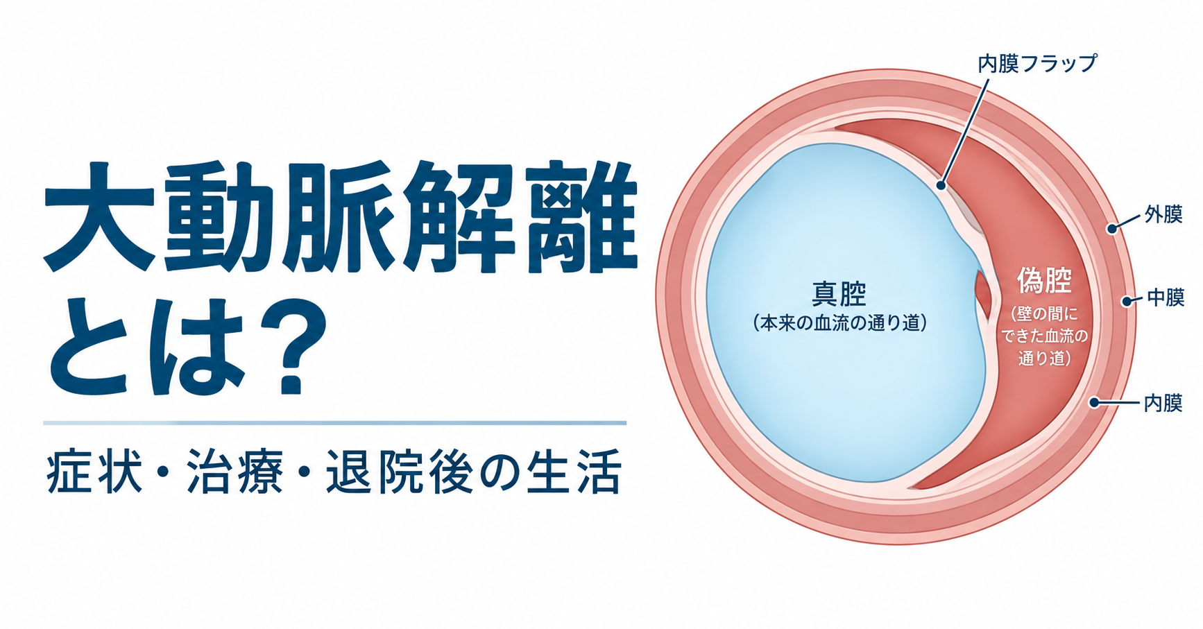 「大動脈解離とは?」の文字と、大動脈の壁の中に偽腔ができた断面模式図