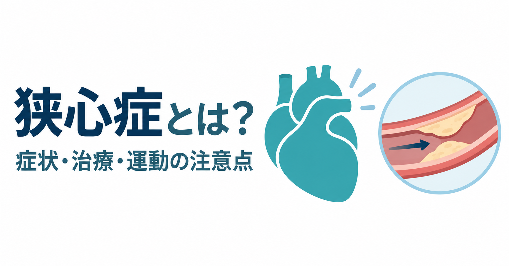 「狭心症とは?」の文字と、心臓および内側が狭くなった冠動脈の模式図