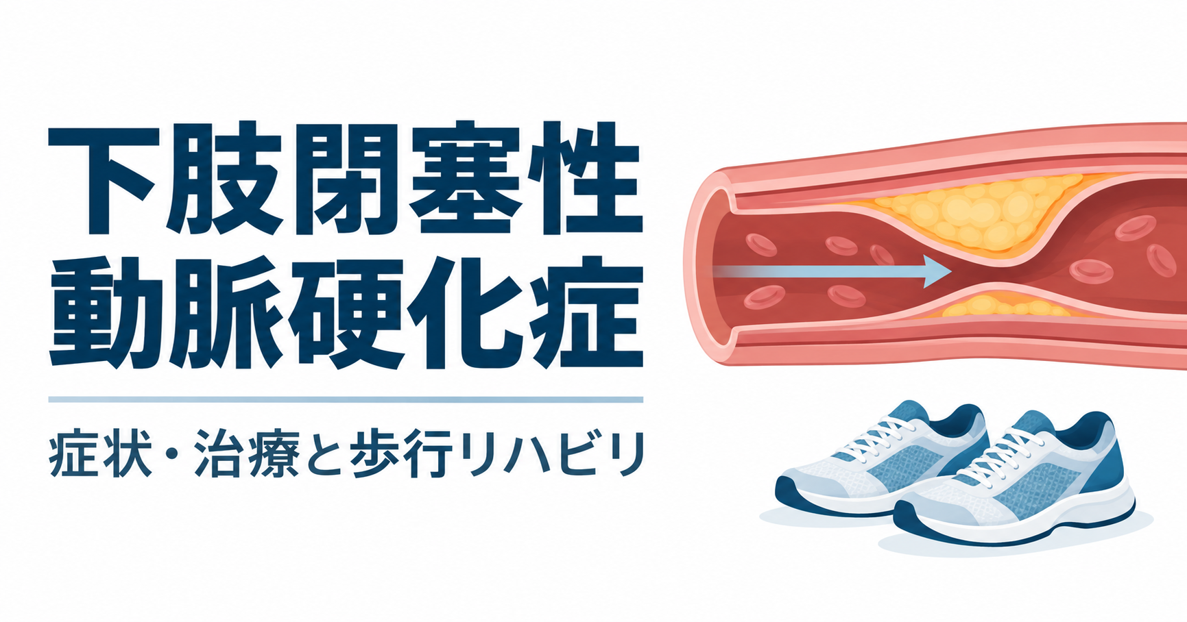 下肢閉塞性動脈硬化症の症状・治療と歩行リハビリを示す、狭くなった動脈と歩行用の靴のイラスト