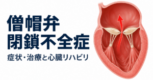 僧帽弁閉鎖不全症 症状・治療と心臓リハビリ」の文字と、左心室から左心房への逆流を示す模式図